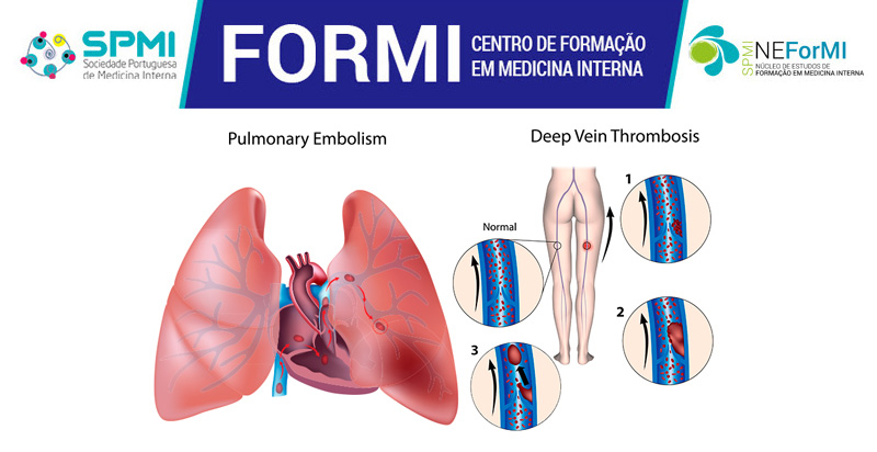 Curso Tromboembolismo Venoso e Ecodoppler Venoso dos Membros Inferiores - Abertas as Inscrições